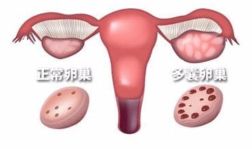 多囊卵巢综合症